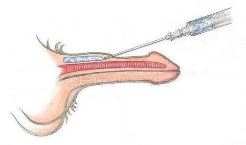 Penisvergrößerung mit Injektionen
