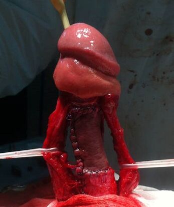 Betrieb, um den Penis zu erhöhen